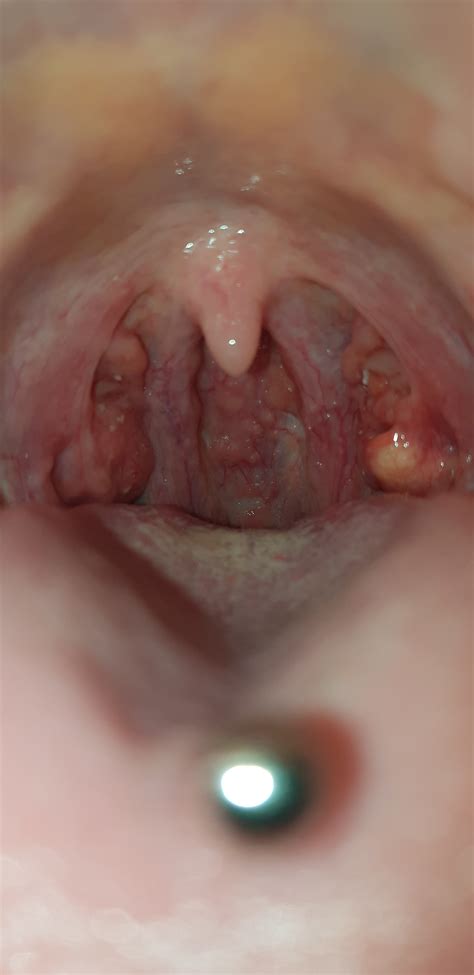 What Could Cause A White Lump On The Tonsil In Someone With Recurrent