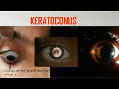 Keratoconus A Video Compilation Of Munson Sign Rizzuti Sign Oil