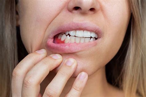 What Are The Natural Treatments For Bleeding Gums Oris Dental Center