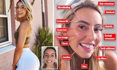 Personal Trainer 30 Reveals Why She S Getting 7 000 Worth Of Botox And Fillers Drained From