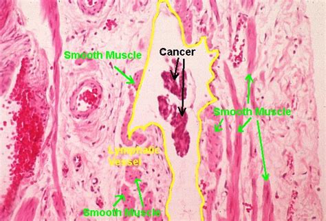 Basic Histology Cancer Cells In A Lymphatic Vessel