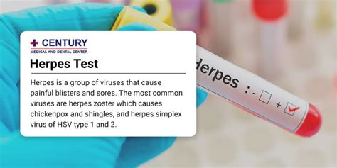 4 Reasons Not To Freak Out About Your Positive Herpes Test Century Medical And Dental Center