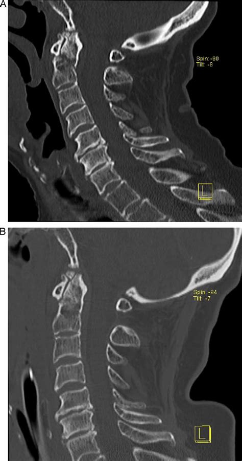 Computed Tomography Scan Of The Cervical Spine A The Scan