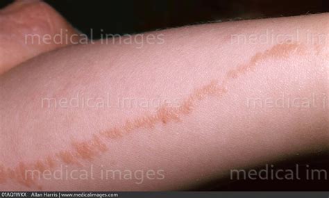 Stock Image Dermatology Lichen Striatus Small Red Bumps Following A