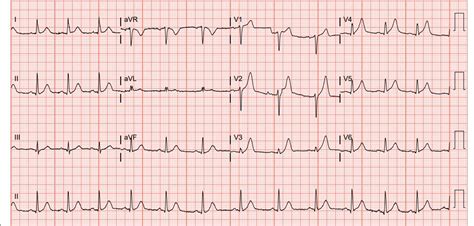 Myocardial Infarction Ecg Interpretation