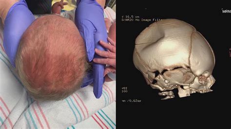 Doctors Get Creative To Help Baby Born With Dent In Skull