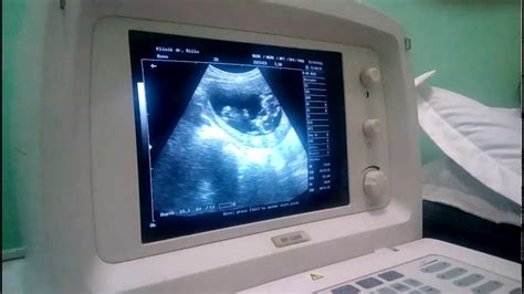 Faktor yang memengaruhi keberhasilan hamil bayi kembar antara lain: usg bayi kembar - YouTube
