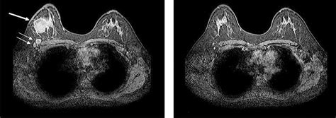 Management Of Breast Cancer—part I The Bmj