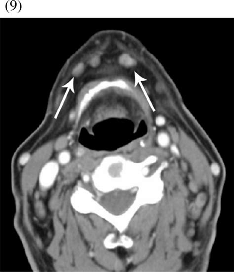9 Level Ia Submental Nodes Ct Scan At The Level Of Open I