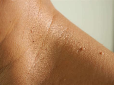 How To Identify And Remove A Skin Tag Business Insider India