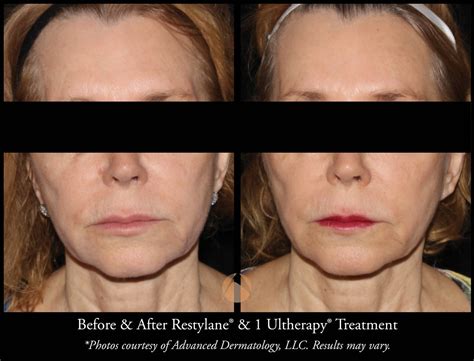 Lower Face Aging Treatment For Double Chins Chicago Il Advanced