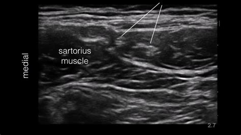 Lateral Femoral Cutaneous Nerve Dividing When Scan Distally Youtube