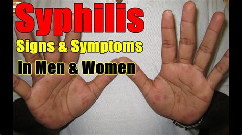 Syphilis Signs And Symptoms In Men And Women Youtube