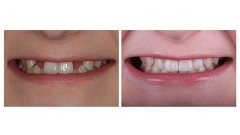 Palmetto Dental Associates — Missing Lateral Incisors