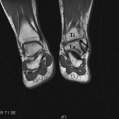 Mri T2 Image Is Showing Sagittal Section Of The Ankle Joint Of A