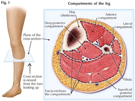 What Is Compartment Syndrome Legs On Fire