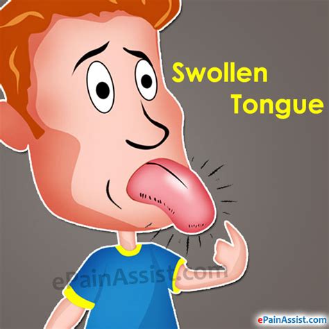 Swollen Tongue Treatment Home Remedies Symptoms Causes