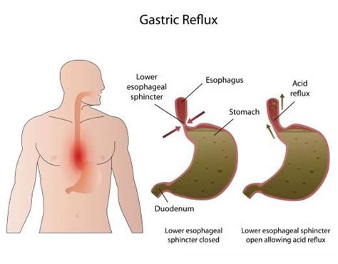 Esophageal Spasms Disease Reference Guide Drugs Hot Sex Picture