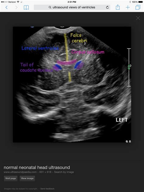 Neonatal Head Ultrasound Anatomy