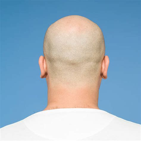 Top 102 Pictures Bald Spot On Back Of Head Female Stunning 102023