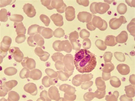 Blood Eosinophil Levels In Copd Too Variable For Biomarker Use