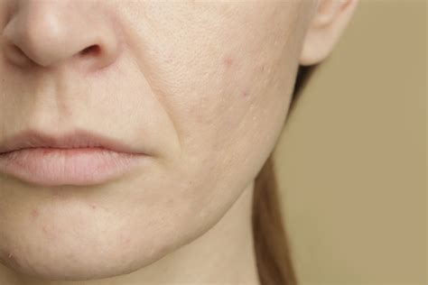 Large Skin Pores