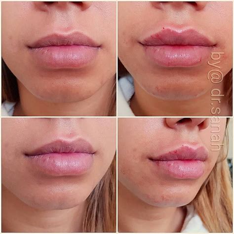 Cupid S Bow Lip Filler Before And After Before And After