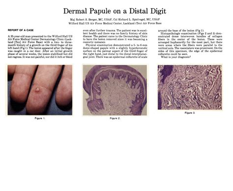 Dermal Papule On A Distal Digit Jama Dermatology Jama Network