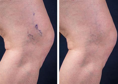 Sclerotherapy For Varicose Veins Vascular And Interventional Specialists
