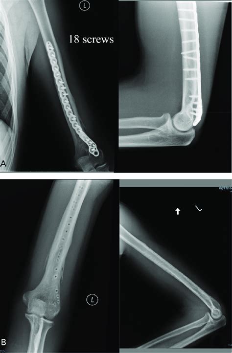 A A Long Titanium Precontoured Distal Humeral Plate Was Used To Download Scientific Diagram