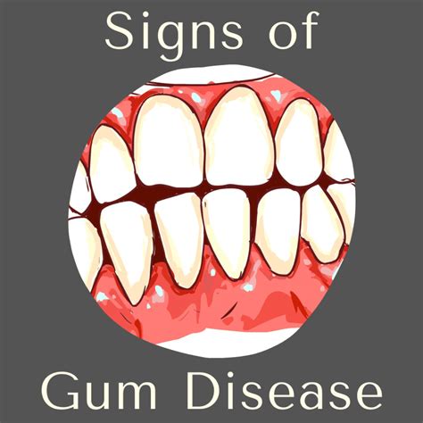 Signs Of Gum Disease Channo Dds