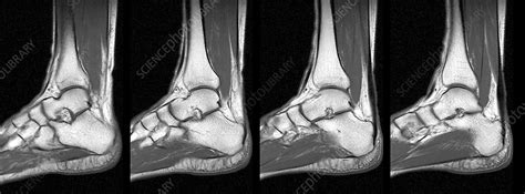 Normal Ankle Mri Scans Stock Image C0147070 Science Photo Library