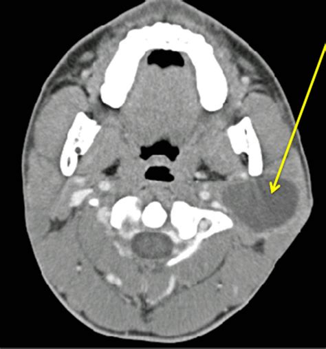 Atypical Parotid Gland Cystic Deep Left Involving Neoplasm Showtainment