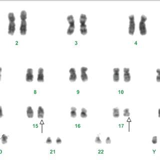 Conventional Karyotyping Partial G Banded Karyotype Showing