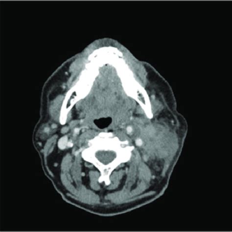 Computed Tomography Scan Of The Neck With Contrast Pre Treatment
