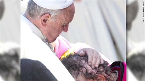 Pope Francis Embrace Of A Severely Disfigured Man Touches World Cnn