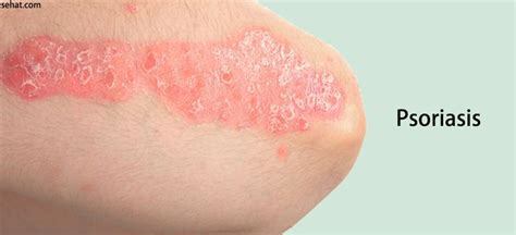 Psoriasis What You Need To Know Sehat