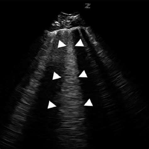 Ultrasound Images Of The Airway A Image At The Hyoid Bone Level The