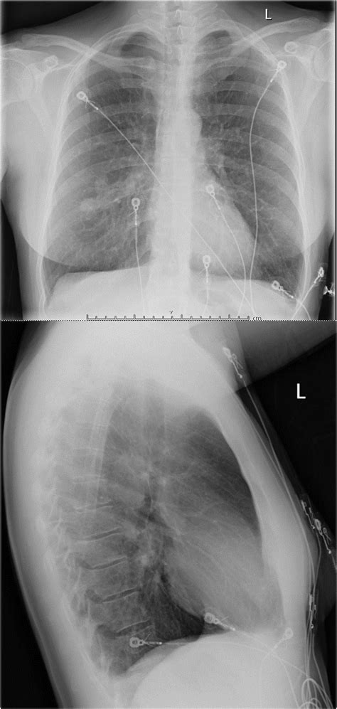 A Chest X Ray Ap And Lateral View Showing Right Mid Zone Mass Lesion