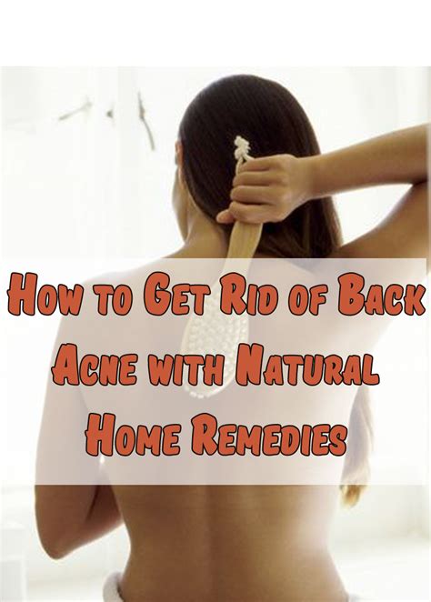 How To Get Rid Of Back Acne With Natural Home Remedies Healthamania