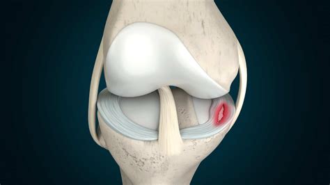 What Is A Meniscus Tear And How Can I Treat It Northeast Spine And Sports Medicine