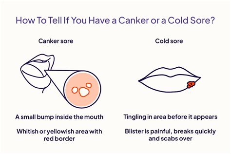 Canker Sore Vs Cold Sore Symptoms Causes And Treatment