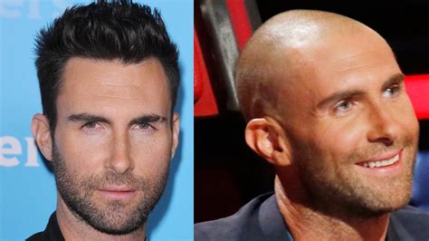 Top Celebrity Hair Transplants Babbletop
