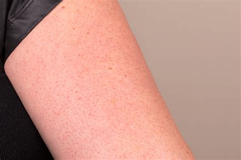 How To Treat Keratosis Pilaris Those Scaly Red Bumps On Your Upper Arms Beautylish
