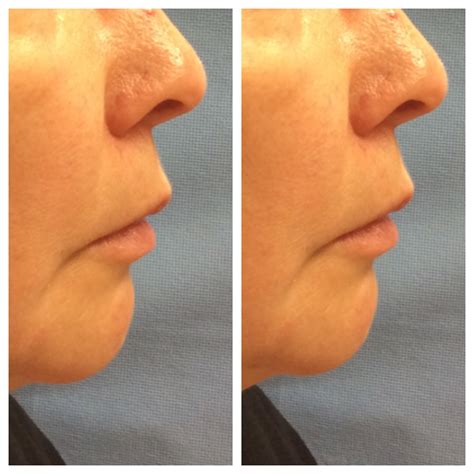 Radiesse® Before And After Photos Lisa Bunin Md