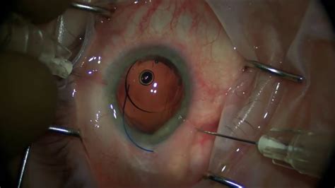 Four Surgical Pearls For The Yamane Scleral Fixation Technique Youtube