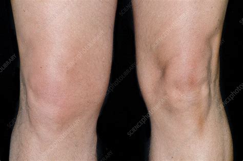 Swollen Knee From Torn Ligament Stock Image C0135890 Science