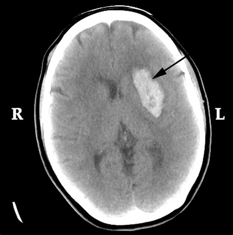 Cranial Hemorrhage