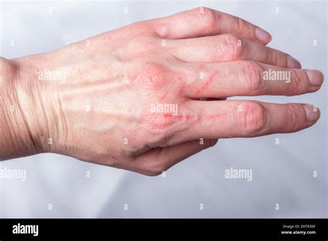 Cat Scratch Wound Woman Hi Res Stock Photography And Images Alamy