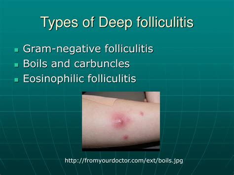 Ppt Folliculitis By Nicole Pitt Powerpoint Presentation Free